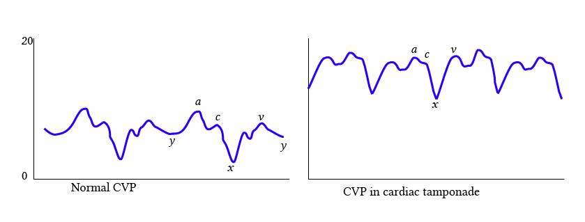 Cardiac Tamponade Deranged Physiology