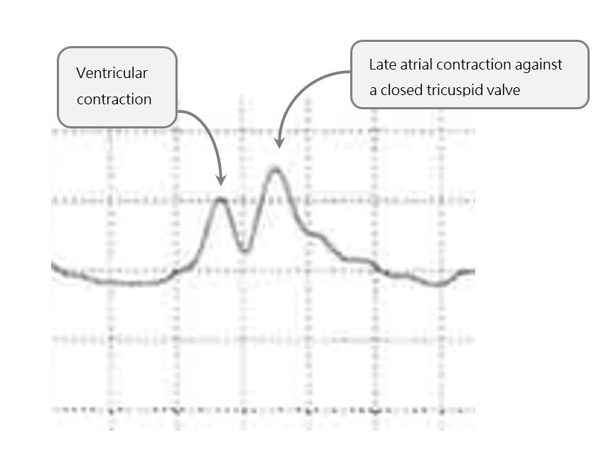 atrioventricular lead reversal CVP waveform