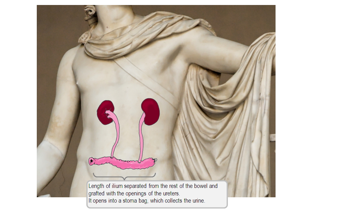 ureteric diversion diagram