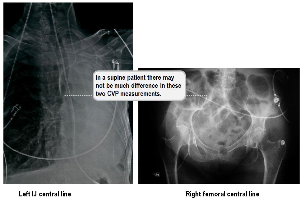 There is no difference in CVP measurements between femoral and IJ lines, if the patient is supine