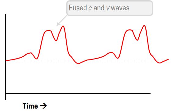 CVP fused c and v waves