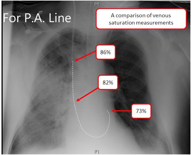a comparison of venous saturation measurments