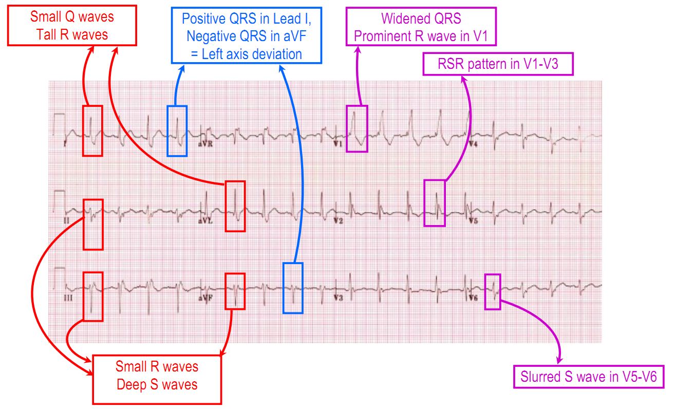 Bifascicular block - RBBB and LPFB