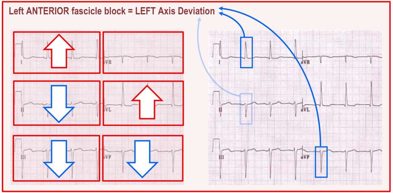 left anterior fascicle block summary