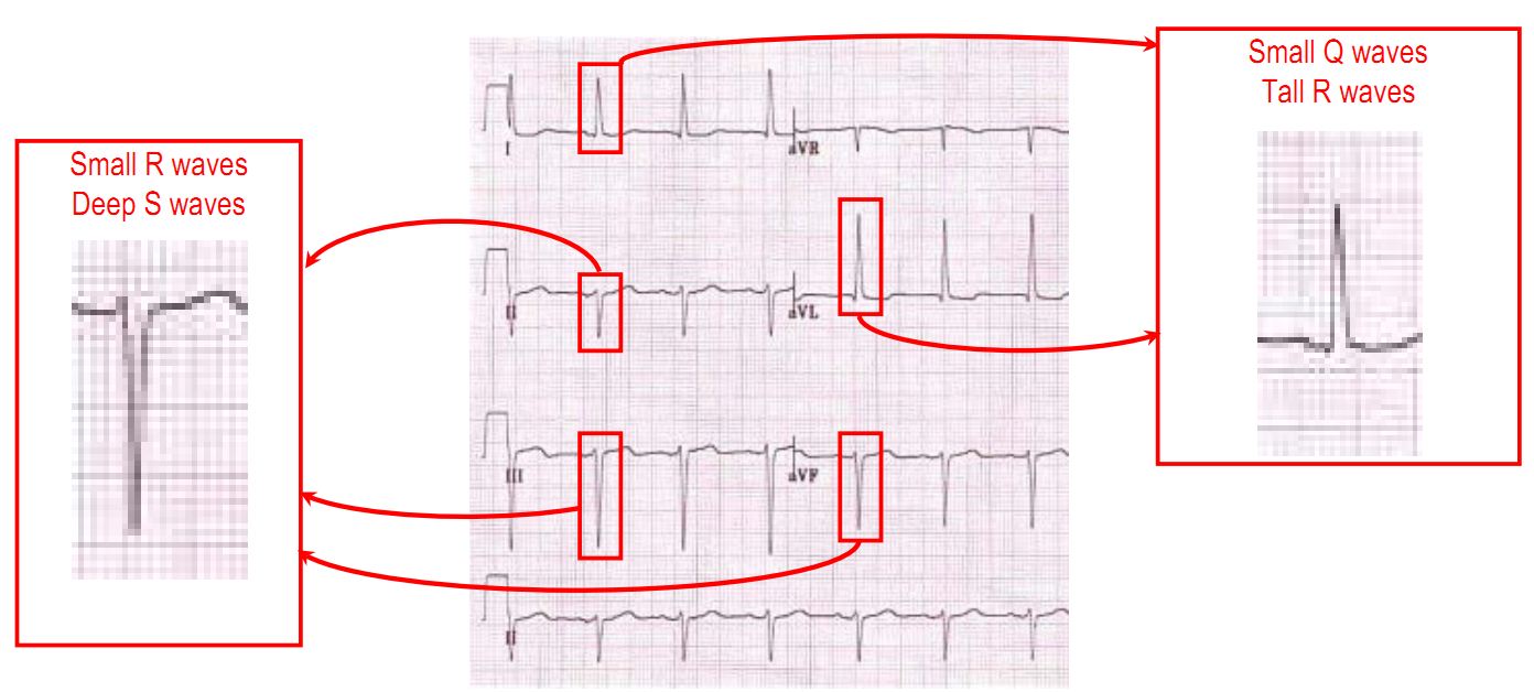 left anterior fascicle block