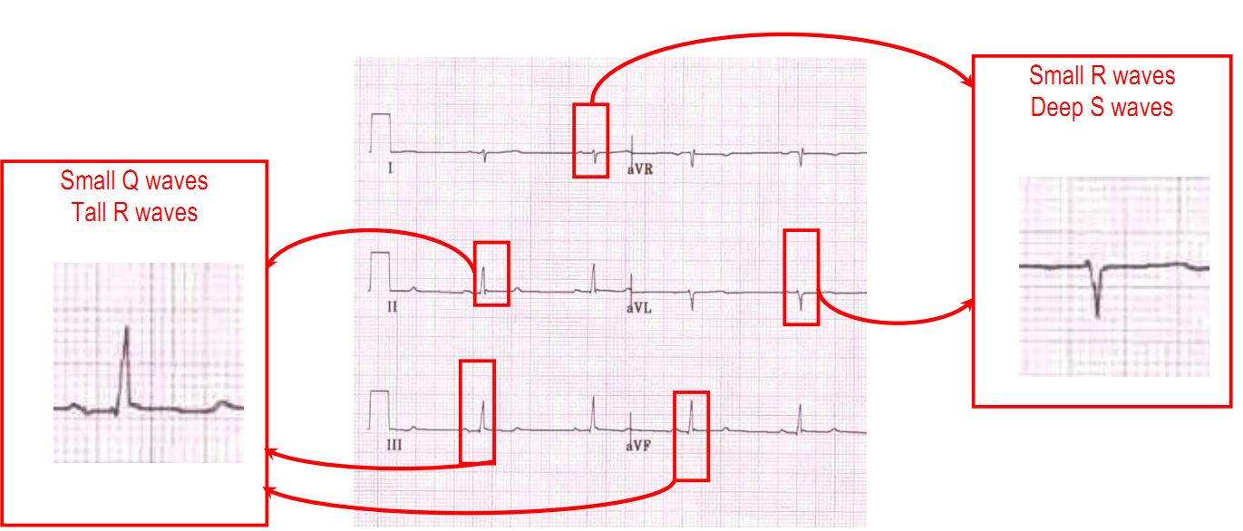 left posterior fascicle block