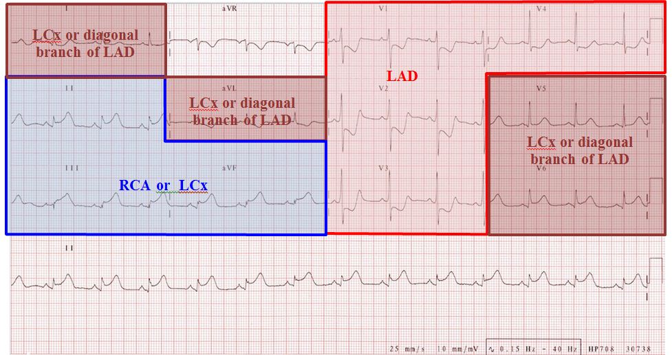 localisation of coronary artery territories