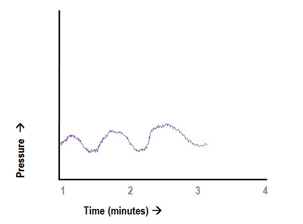 ICP B-wave EVD waveform.JPG