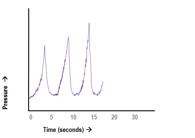 ICP ramp-like B-wave EVD waveform.JPG