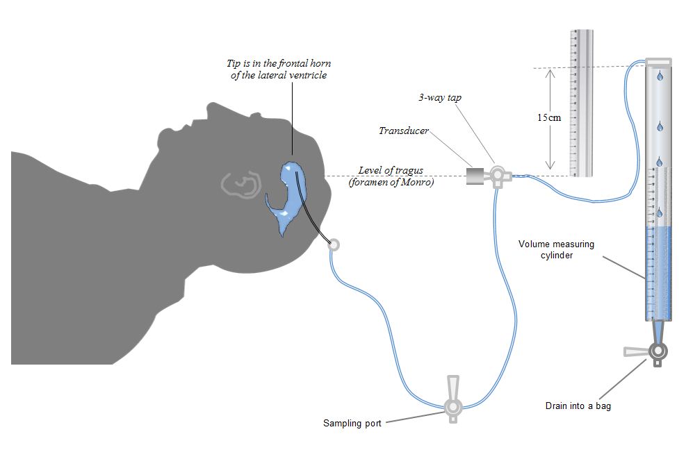 anatomy of the evd