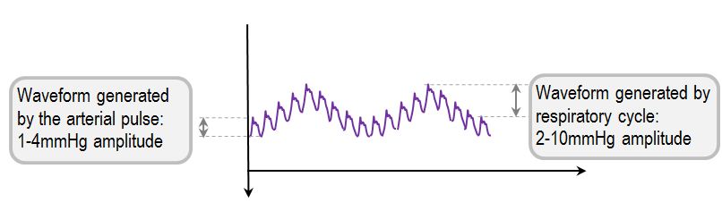 normal EVD waveform