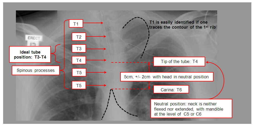 Ideal position of the Endotracheal tube on a plain mobile Xray