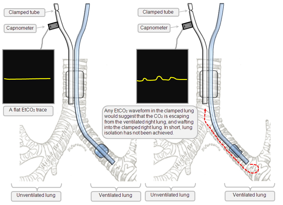 capnometry in checking the quality of lung isolation with a DLT