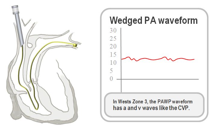 PAC wedged in the PA
