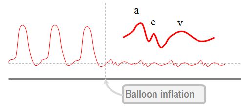 PAWP waveform