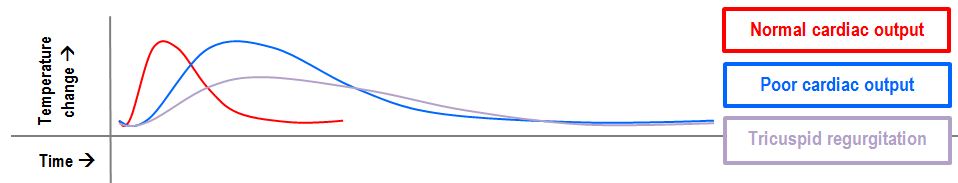 thermodilution curves for measuring cardiac output