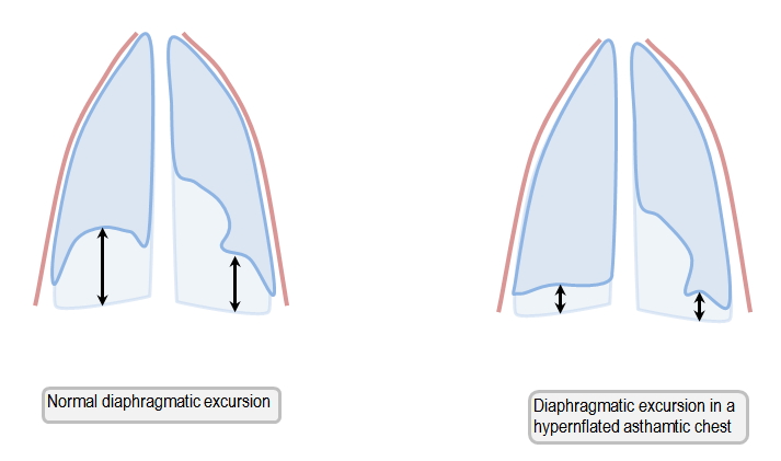 mechanics of diaphragmatic excursion in hyperinflation