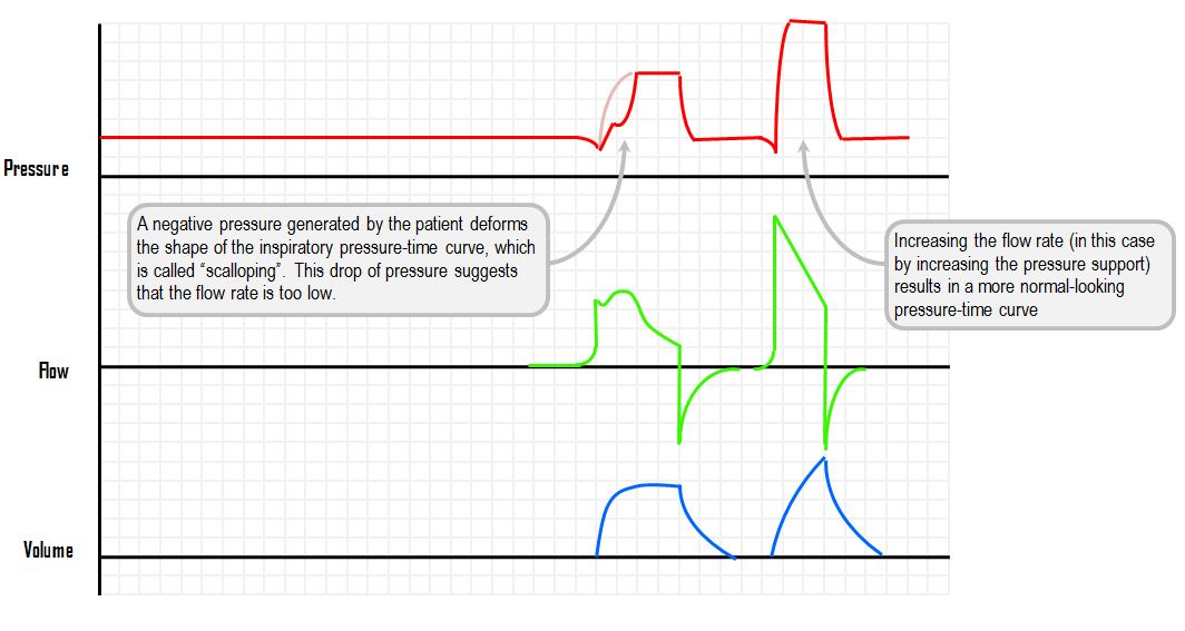 patient-ventilatory dyssynchrony – scalloping of the pressure-time curve with inadequate flow rate