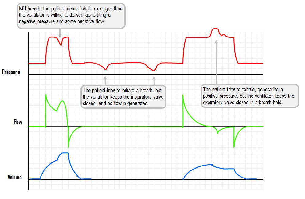 patient-ventilatory dyssynchrony - example of wasted effort in a mandatory mode