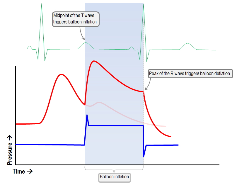 ECG triggers of IABP inflation and deflation