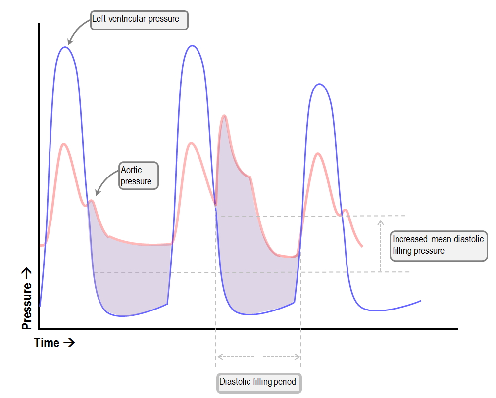Effect of IABP ondiastolic pressure time index.jpg