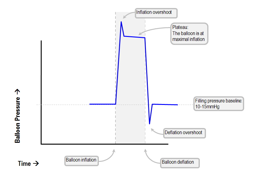 balloon waveform