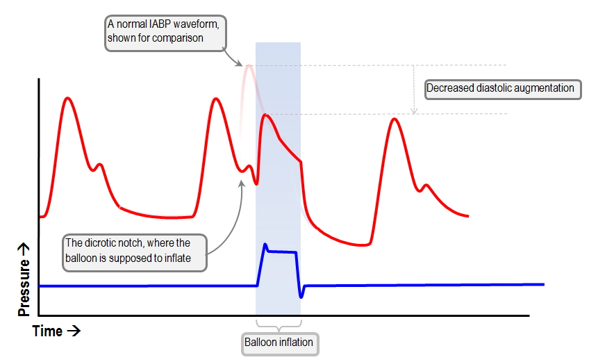 decreased diastolic augmentation with late inflation