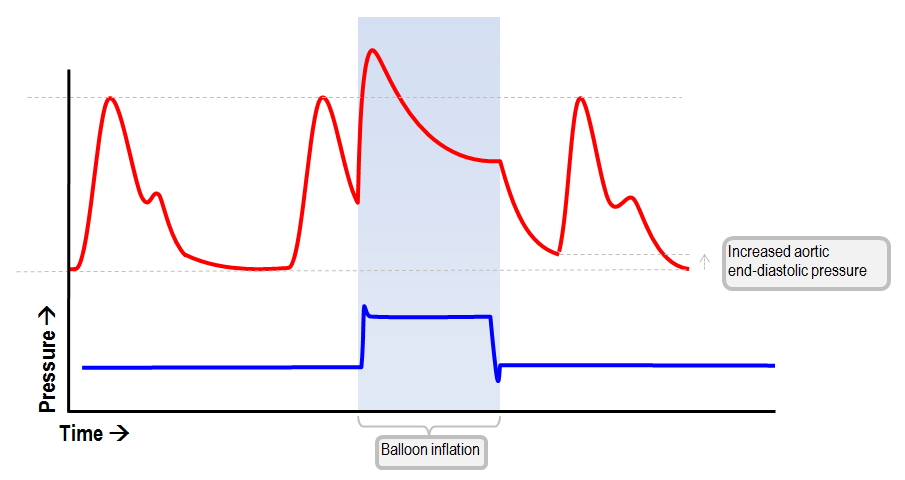 late IABP deflation increases afterload