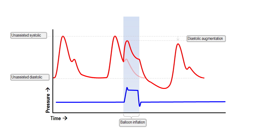 poor diastolic augmentation