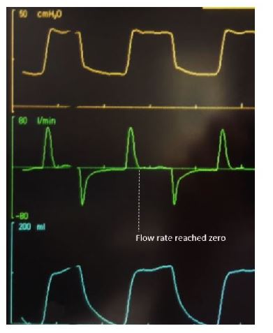pressure control ventilation flow rate reaches zero