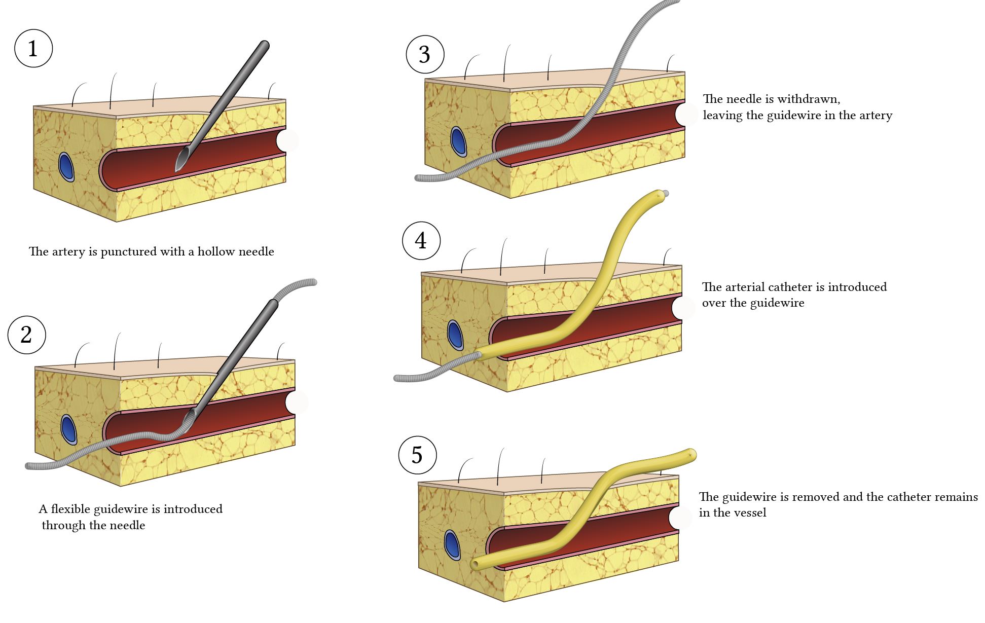 Seldinger technique for arterial cannulatio