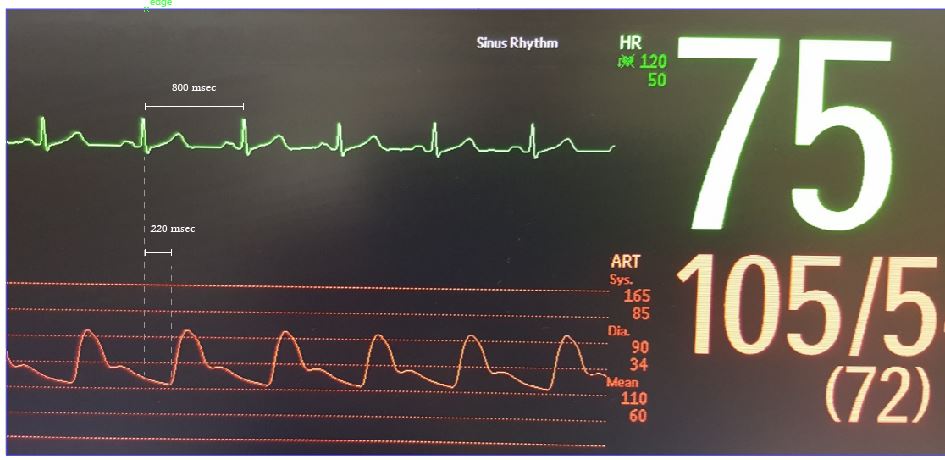 arterial line and ECG timing in a real example
