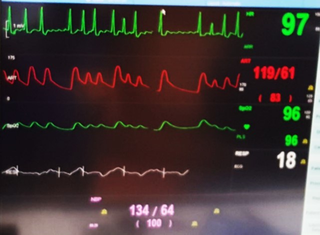 The Arterial Line : Clinical practices arterial line tips yale em