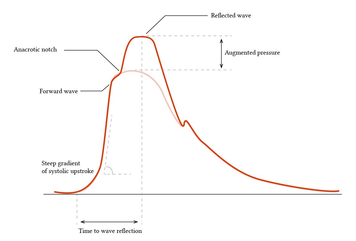 arterial pressure waveform in a hypertensive patient