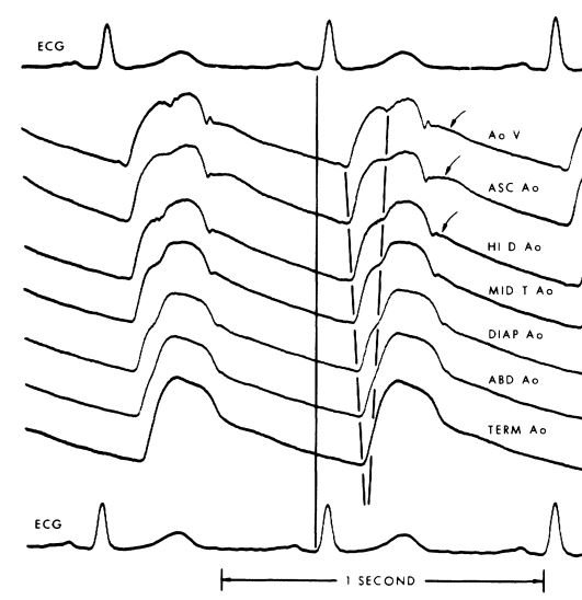 arterial waveforms along the length of the aorta - Murgo et al, 1980