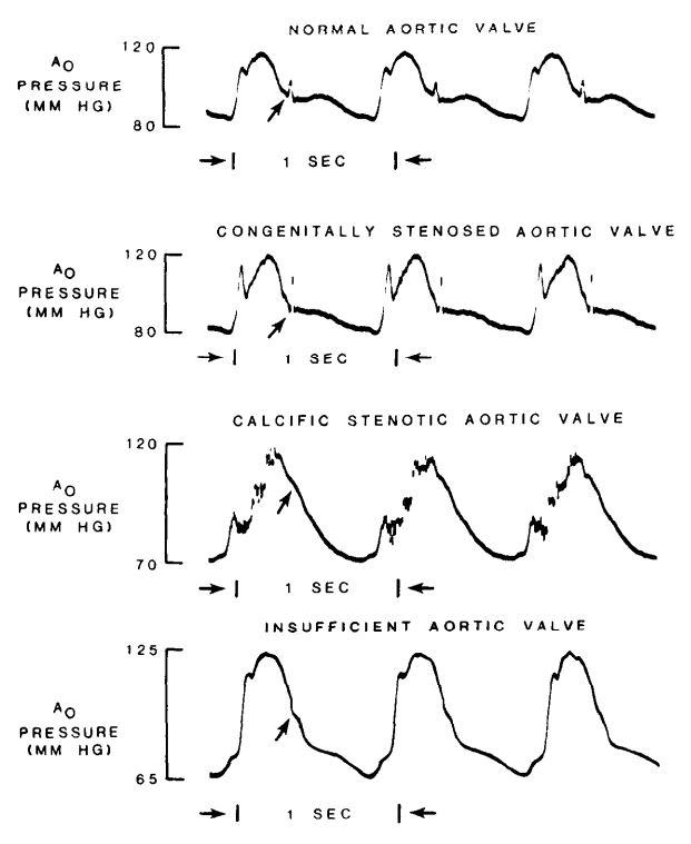 different shapes of the dicrotic notch due to aortic valve pathology