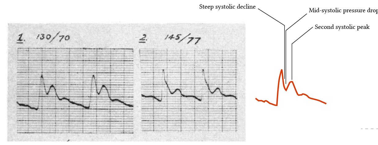 arterial waveform in HOCM