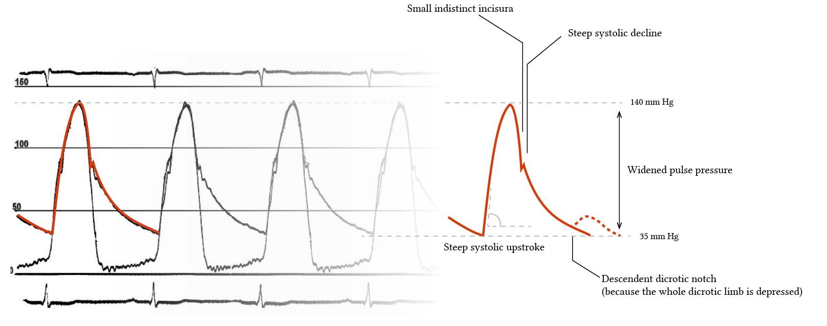 arterial pressure waveform in aortic regurgitation