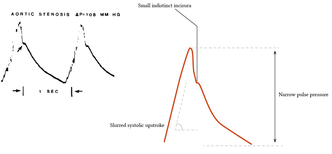 example of an arterial line waveform with severe aortic stenosis
