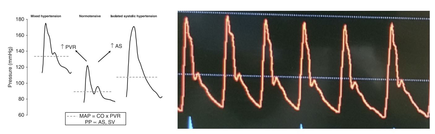 example of an arterial pressure waveform in hypertension