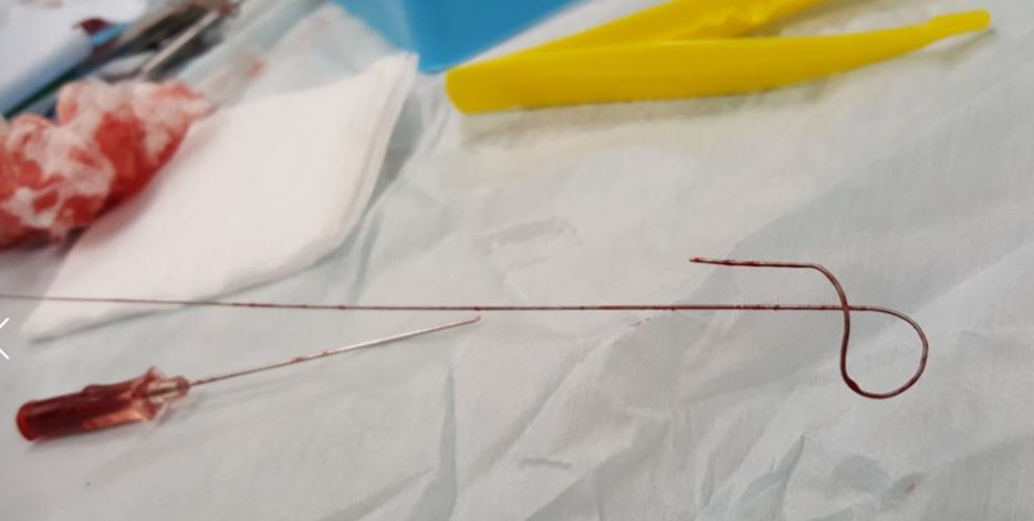 kinked arterial line Seldinger wire. They should have asked for help a few minutes ago.