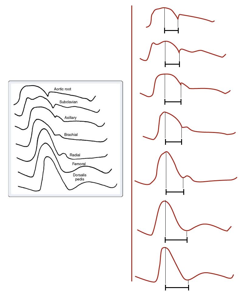 Normal arterial line waveforms - Deranged Physiology