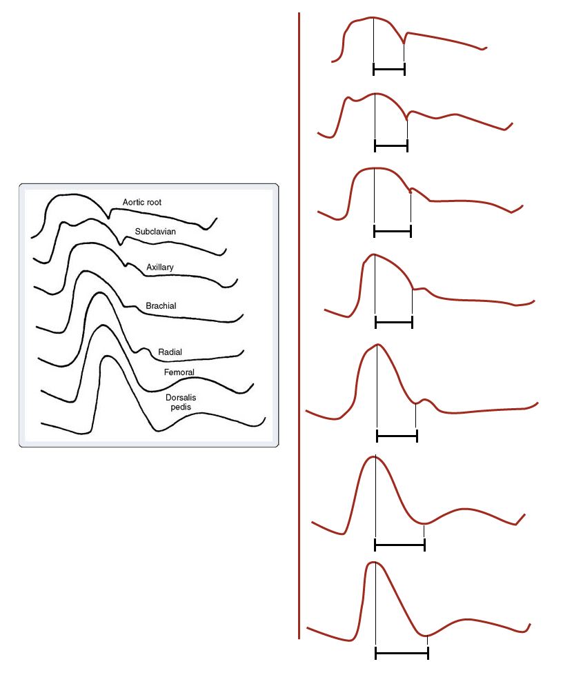 progressive delay in dicrotic notch position