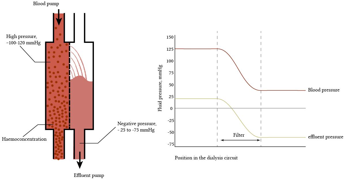 ultrafiltration pressures in the dialysis circuit - sans detail.
