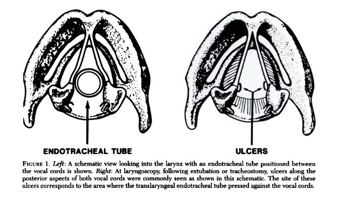 ETT-associated laryngeal ulceration from colice et al (1989)
