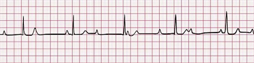 Atrioventricular Block, Heart Block