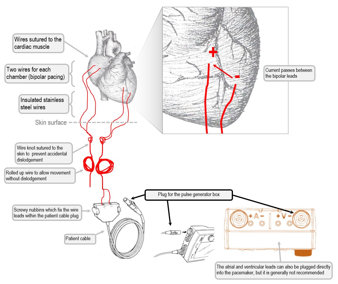 Anatomy Of The Temporary Pacemaker Circuit Deranged Physiology
