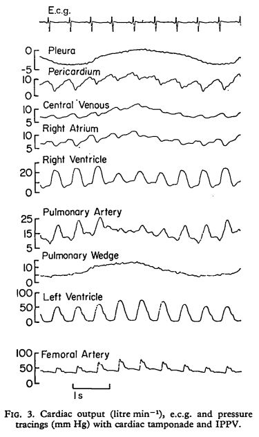 Cardiac Tamponade Deranged Physiology