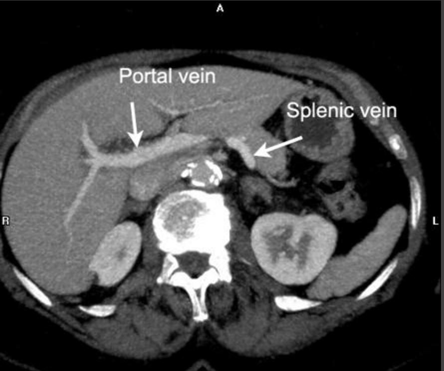 location of the portal vein on CT