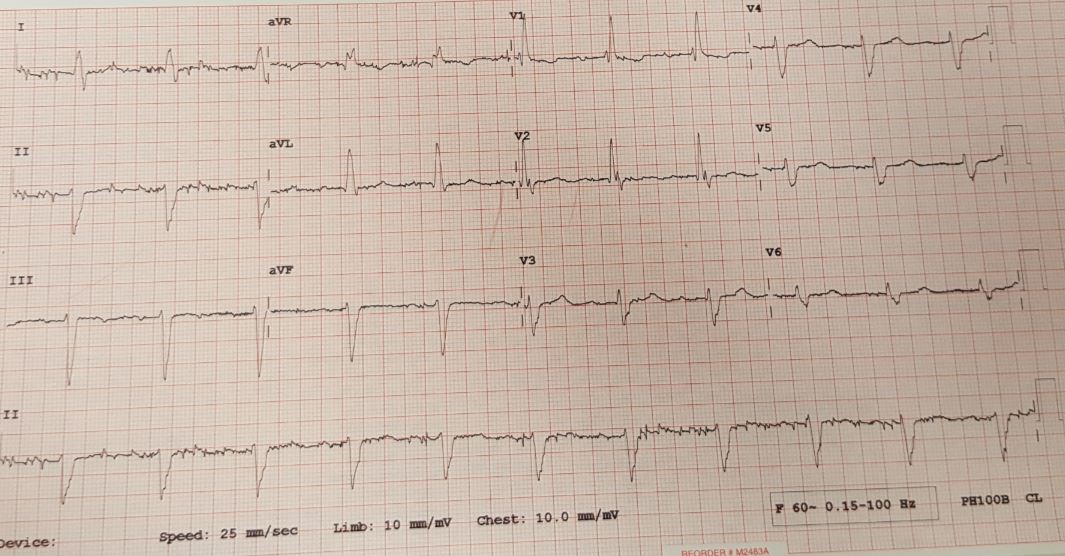 trifascicular block